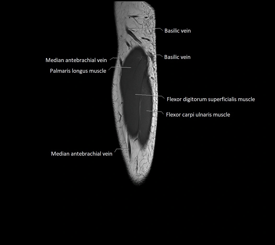 MRI 3T forearm sagittal labelled cross sectional anatomy image 37.webp